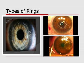 Types of Rings
 