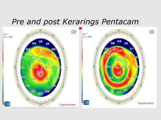 Pre and post Kerarings Pentacam
 