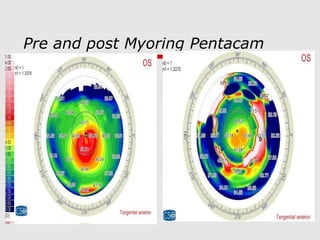 Pre and post Myoring Pentacam
 