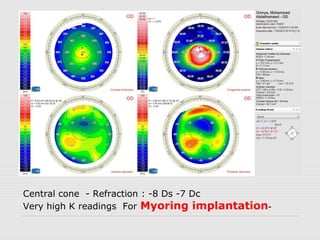 Central cone - Refraction : -8 Ds -7 Dc
-Very high K readings For Myoring implantation
 