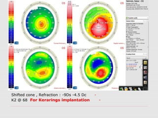 -Shifted cone , Refraction : -9Ds -4.5 Dc
-K2 @ 68 For Kerarings implantation
 