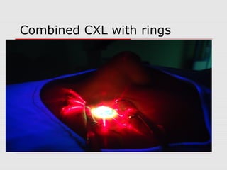 Combined CXL with rings
 