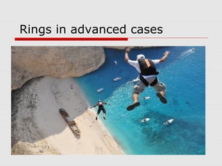 Rings in advanced cases
 