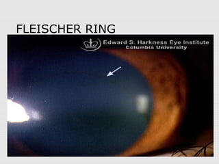 FLEISCHER RING
 