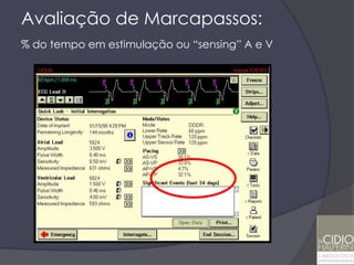 Avaliação de Marcapassos:
% do tempo em estimulação ou “sensing” A e V
 