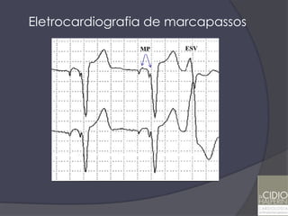 Eletrocardiografia de marcapassos
                MP       ESV

                     E   E
 