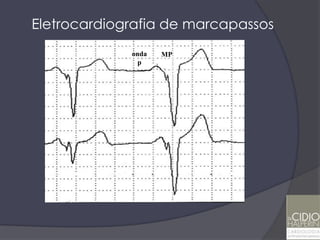 Eletrocardiografia de marcapassos
    P         P
             ondaS   P
                     E
                     MP
               p
 