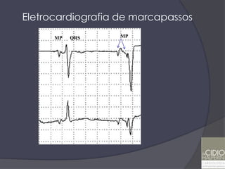 Eletrocardiografia de marcapassos
      MP           MP
           SQRS
      E           E
 