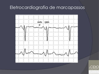 Eletrocardiografia de marcapassos

             S S
            onda   QRS
              p
 