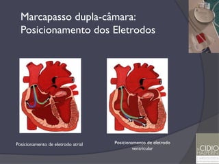 Marcapasso dupla-câmara:
  Posicionamento dos Eletrodos




Posicionamento de eletrodo atrial   Posicionamento de eletrodo
                                             ventricular
 