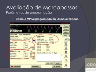Avaliação de Marcapassos:
Parâmetros de programação
      Como o MP foi programado na última avaliação
 