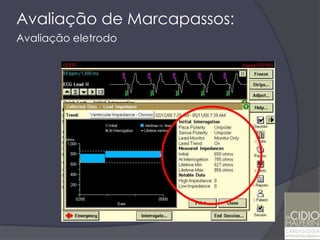 Avaliação de Marcapassos:
Avaliação eletrodo
 