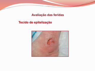 avaliacao-das-feridas-ppt