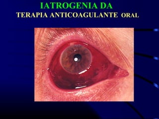 IATROGENIA DA
TERAPIA ANTICOAGULANTE ORAL
 