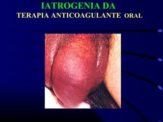 IATROGENIA DA
TERAPIA ANTICOAGULANTE ORAL
 
