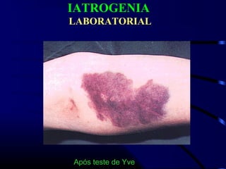 IATROGENIA
LABORATORIAL
Após teste de Yve
 