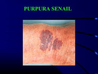 PURPURA SENAIL
 