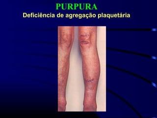 PURPURA
Deficiência de agregação plaquetária
 