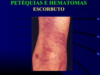 PETÉQUIAS E HEMATOMAS
ESCORBUTO
 