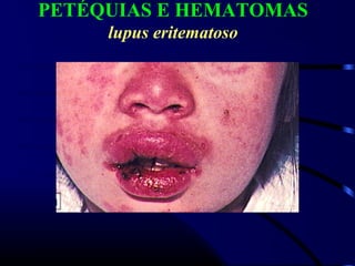 PETÉQUIAS E HEMATOMAS
lupus eritematoso
 