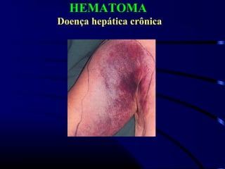 HEMATOMA
Doença hepática crônica
 