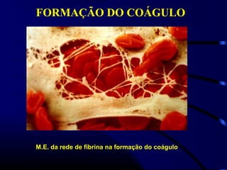 M.E. da rede de fibrina na formação do coágulo
FORMAÇÃO DO COÁGULO
 