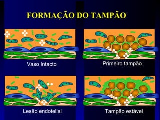 Vaso Intacto
Lesão endotelial
Primeiro tampão
Tampão estável
FORMAÇÃO DO TAMPÃO
 