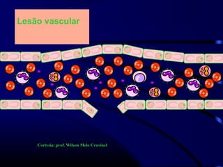 Lesão vascular
Cortesia: prof. Wilson Melo Cruvinel
 