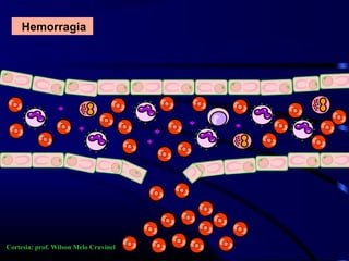 Hemorragia
Cortesia: prof. Wilson Melo Cruvinel
 