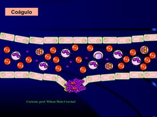 Coágulo
Cortesia: prof. Wilson Melo Cruvinel
 
