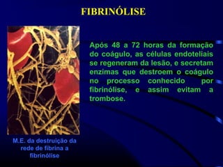 FIBRINÓLISE
M.E. da destruição da
rede de fibrina a
fibrinólise
Após 48 a 72 horas da formação
do coágulo, as células endoteliais
se regeneram da lesão, e secretam
enzimas que destroem o coágulo
no processo conhecido por
fibrinólise, e assim evitam a
trombose.
 