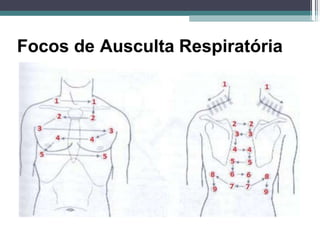 Focos de Ausculta Respiratória
 