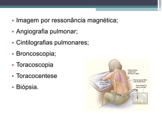• Imagem por ressonância magnética;
• Angiografia pulmonar;
• Cintilografias pulmonares;
• Broncoscopia;
• Toracoscopia
• Toracocentese
• Biópsia.
 