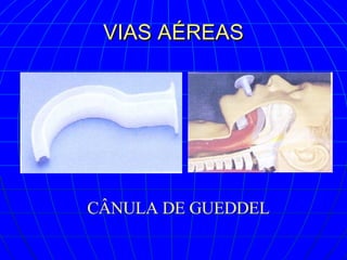 VIAS AÉREAS CÂNULA DE GUEDDEL 
