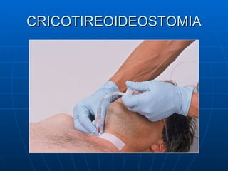 CRICOTIREOIDEOSTOMIA 