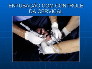 ENTUBAÇÃO COM CONTROLE DA CERVICAL 