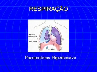 RESPIRAÇÃO Pneumotórax Hipertensivo 