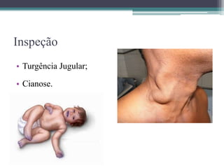 Inspeção
• Turgência Jugular;
• Cianose.
 