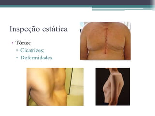 Inspeção estática
• Tórax:
▫ Cicatrizes;
▫ Deformidades.
 