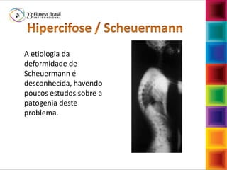Fábio Mazzola
A etiologia da
deformidade de
Scheuermann é
desconhecida, havendo
poucos estudos sobre a
patogenia deste
problema.
 