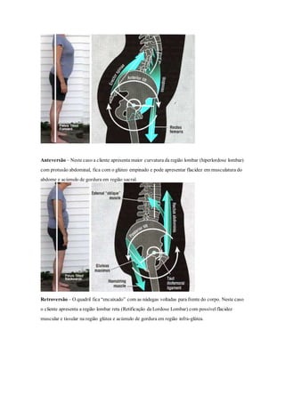 Anteversão – Neste caso a cliente apresenta maior curvatura da região lombar (hiperlordose lombar)
com protusão abdominal, fica com o glúteo empinado e pode apresentar flacidez em musculatura do
abdome e acúmulo de gordura em região sacral.
Retroversão – O quadril fica “encaixado” com as nádegas voltadas para frente do corpo. Neste caso
o cliente apresenta a região lombar reta (Retificação da Lordose Lombar) com possívelflacidez
muscular e tissular na região glútea e acúmulo de gordura em região infra-glútea.
 