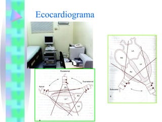 Ecocardiograma
 