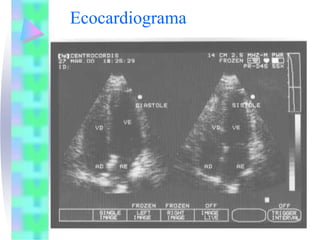 Ecocardiograma
 