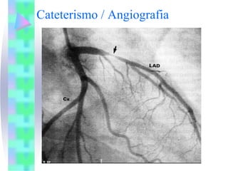 Cateterismo / Angiografia
 