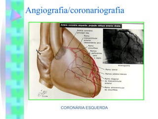 Angiografia/coronariografia




         CORONÁRIA ESQUERDA
 