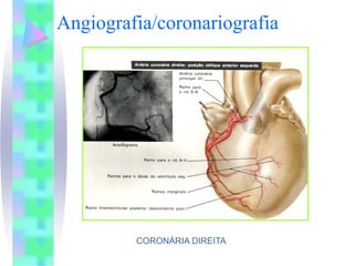 Angiografia/coronariografia




         CORONÁRIA DIREITA
 