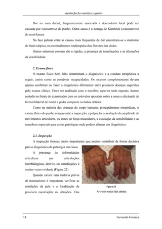 Avaliação do membro superior
18 Fernando Fonseca
Figura 22
Artrose nodal dos dedos
Dor na zona dorsal, frequentemente associada a desconforto local pode ser
causada por osteoartrose do punho. Outra causa é a doença de Kienböck (osteonecrose
do semi-lunar).
Na face palmar entre as causas mais frequentes de dor encontram-se a síndrome
do túnel cárpico, ou eventualmente tendinopatia dos flexores dos dedos.
Outros sintomas comuns são a rigidez, a presença de tumefacções e as alterações
da sensibilidade.
2. Exame físico
O exame físico bem feito determinará o diagnóstico e a conduta terapêutica a
seguir, assim como as possíveis incapacidades. Os exames complementares devem
apenas confirmar ou fazer o diagnóstico diferencial entre possíveis doenças sugeridas
pelo exame clínico. Deve ser realizado com o membro superior todo exposto, doente
sentado na frente do examinador com os cotovelos apoiados sobre a mesa e efectuado de
forma bilateral de modo a poder comparar os dados obtidos.
Como na maioria das doenças do corpo humano, principalmente ortopédicas, o
exame físico do punho compreende a inspecção, a palpação, a avaliação da amplitude de
movimentos articulares, os testes de força musculares, a avaliação da sensibilidade e as
manobras especiais para certas patologias onde podem afirmar um diagnóstico.
2.1. Inspecção
A inspecção fornece dados importantes que podem contribuir de forma decisiva
para o diagnóstico da patologia em causa.
A presença de deformidades
articulares nas articulações
interfalângicas, desvios ou tumefacções é
muitas vezes evidente (Figura 22)
Quando existir uma história prévia
de traumatismo é importante verificar as
condições da pele e a localização de
possíveis escoriações ou abrasões. Elas
 