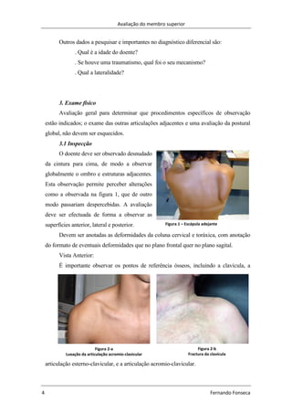 Avaliação do membro superior
4 Fernando Fonseca
Figura 2-b
Fractura da clavícula
Figura 2-a
Luxação da articulação acromio-clavicular
Outros dados a pesquisar e importantes no diagnóstico diferencial são:
. Qual é a idade do doente?
. Se houve uma traumatismo, qual foi o seu mecanismo?
. Qual a lateralidade?
3. Exame físico
Avaliação geral para determinar que procedimentos específicos de observação
estão indicados; o exame das outras articulações adjacentes e uma avaliação da postural
global, não devem ser esquecidos.
3.1 Inspecção
O doente deve ser observado desnudado
da cintura para cima, de modo a observar
globalmente o ombro e estruturas adjacentes.
Esta observação permite perceber alterações
como a observada na figura 1, que de outro
modo passariam despercebidas. A avaliação
deve ser efectuada de forma a observar as
superfícies anterior, lateral e posterior.
Devem ser anotadas as deformidades da coluna cervical e toráxica, com anotação
do formato de eventuais deformidades que no plano frontal quer no plano sagital.
Vista Anterior:
É importante observar os pontos de referência ósseos, incluindo a clavícula, a
articulação esterno-clavicular, e a articulação acromio-clavicular.
Figura 1 – Escápula adejante
 