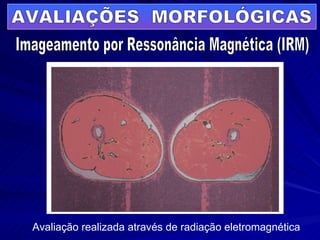 AVALIAÇÕES  MORFOLÓGICAS Imageamento por Ressonância Magnética (IRM) Avaliação realizada através de radiação eletromagnética 