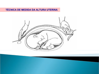 TÉCNICA DE MEDIDA DA ALTURA UTERINA
 